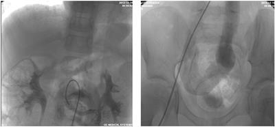 Treatment Option for Abernethy Malformation—Two Cases Report and Review of the Literature